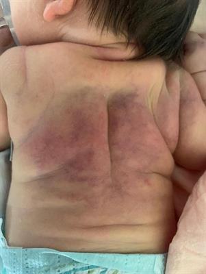 Safety and Efficacy of Pamidronate in Neonatal Hypercalcemia Caused by Subcutaneous Fat Necrosis: A Case Report